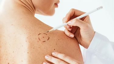 Día Mundial contra el Cáncer. Si bien la exposición al sol aumenta durante el verano, los cuidados deben permanecer todo el año. Día Mundial contra el Cáncer. Si bien la exposición al sol aumenta durante el verano, los cuidados deben permanecer todo el año.