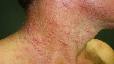 El funcionario remarcó que la disminución de campañas públicas de prevención contribuye directamente al incremento de casos. “Ahora no hay tantas campañas; la información que circula no es la adecuada o no es en la cantidad que debería”, afirmó. El funcionario remarcó que la disminución de campañas públicas de prevención contribuye directamente al incremento de casos. “Ahora no hay tantas campañas; la información que circula no es la adecuada o no es en la cantidad que debería”, afirmó.