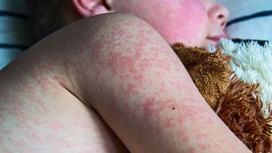 Sarampión: adelantan a los 18 meses la segunda dosis de la vacuna