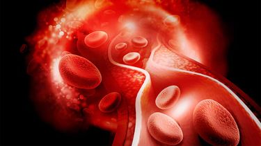 La trombosis es la formación de un coágulo sanguíneo en arterias o venas.