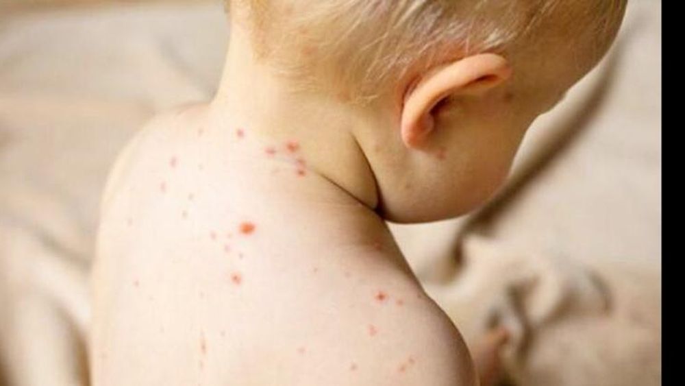 Todos los casos están clasificados como genotipo D8 y esporádicos, ya que no encontró un vínculo epidemiológico claro entre ellos.