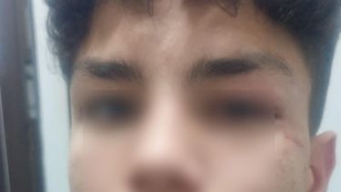Adolescente: En el rostro le produjeron un corte en el rostro y traumatismos cerca del ojo izquierdo. Adolescente: En el rostro le produjeron un corte en el rostro y traumatismos cerca del ojo izquierdo.
